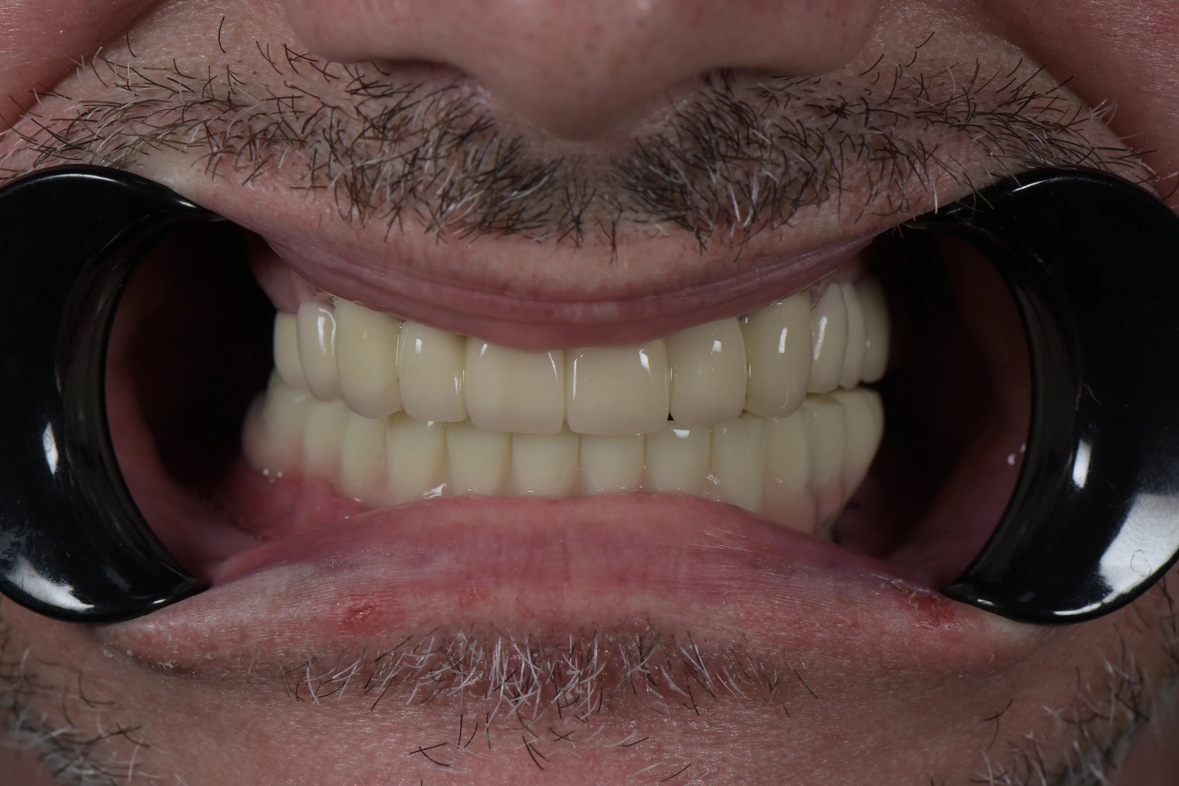 After treatment
