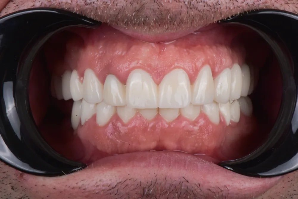 Ceramic crowns — After