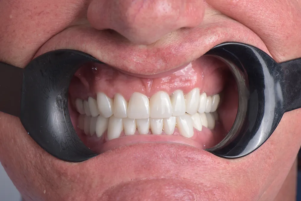 Ceramic crowns — After