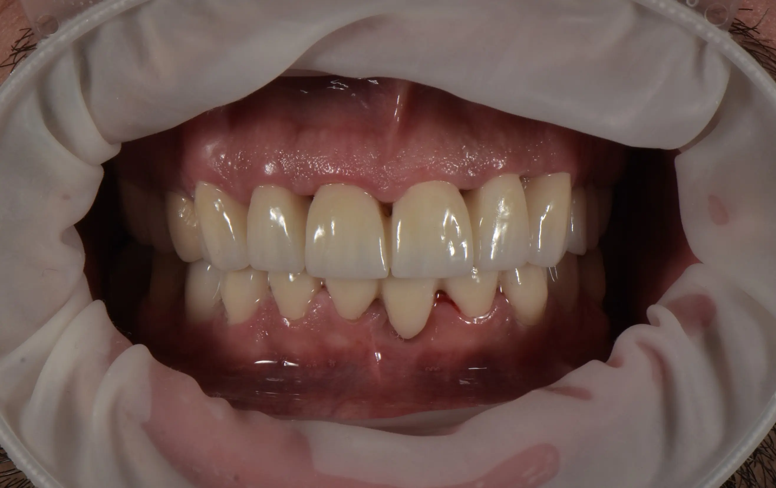 After treatment