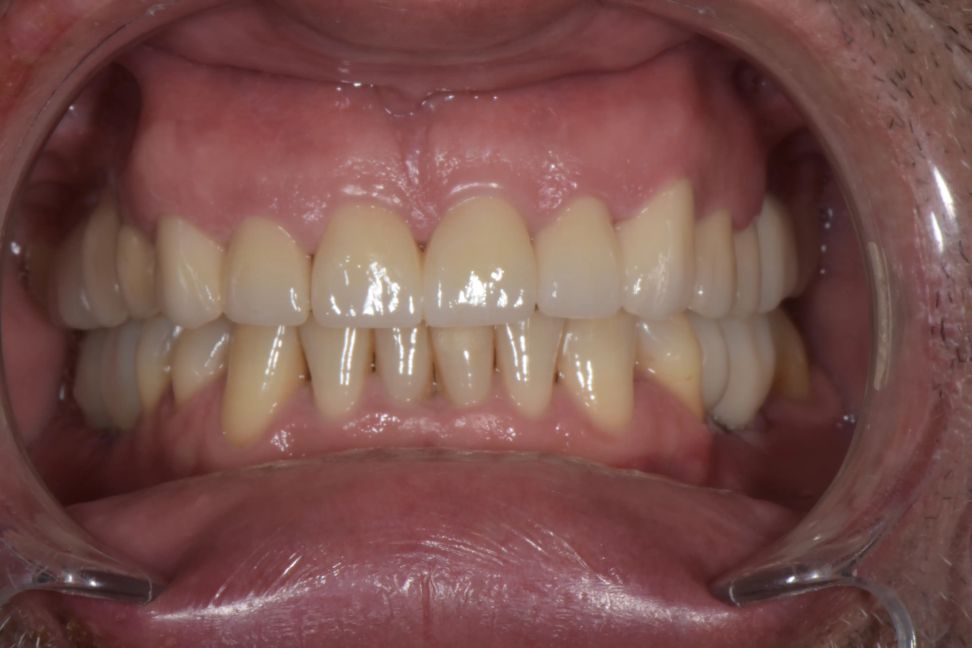 After treatment
