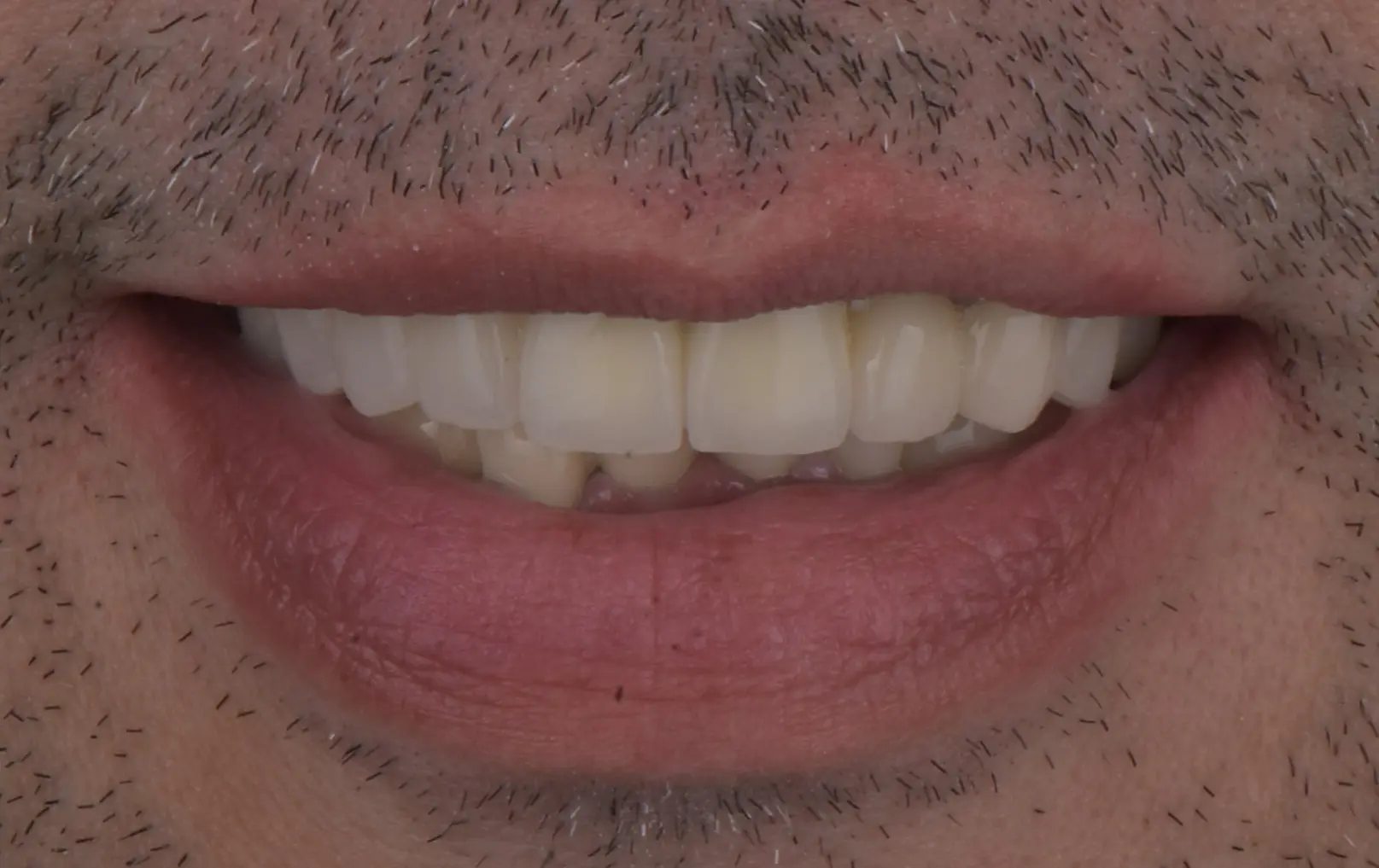 After treatment