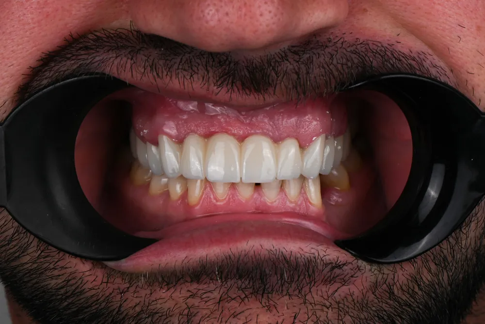 Ceramic crowns — After
