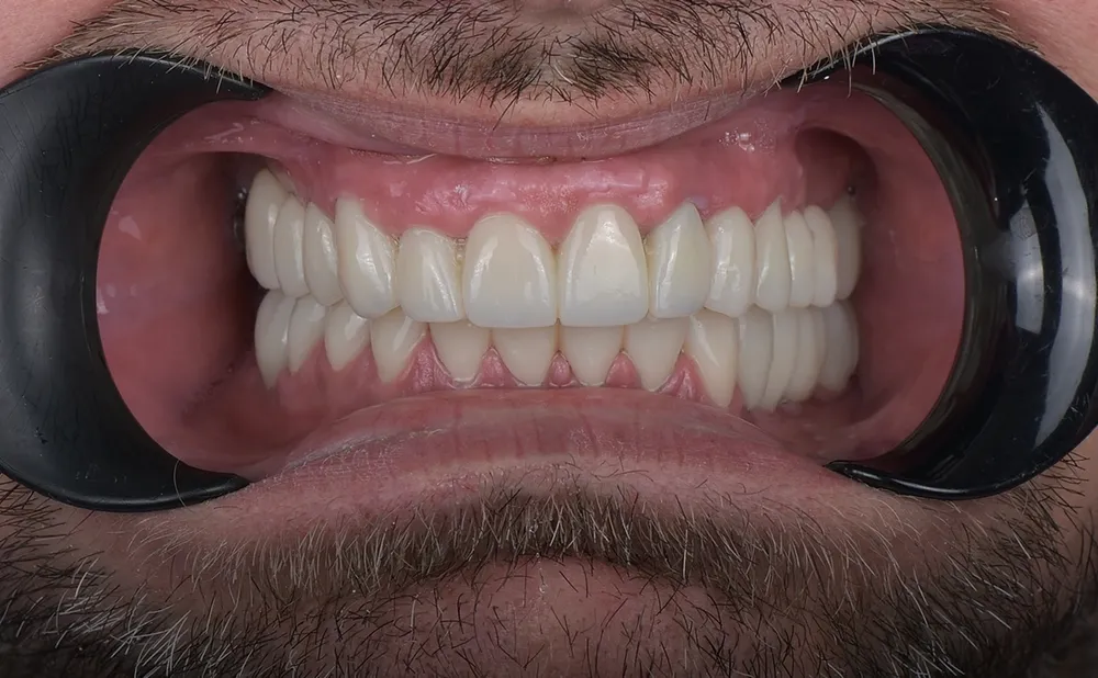 Ceramic crowns — After