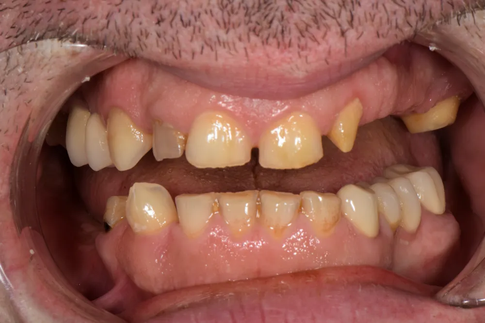Ceramic crowns — Before