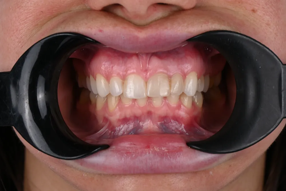 Ceramic crowns — Before