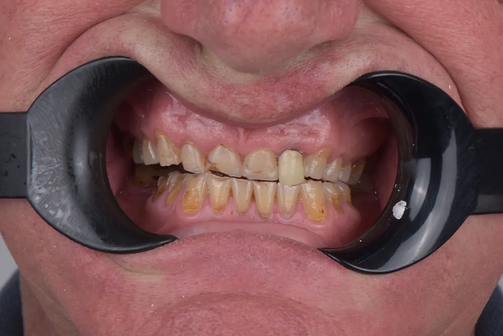 Ceramic crowns — Before