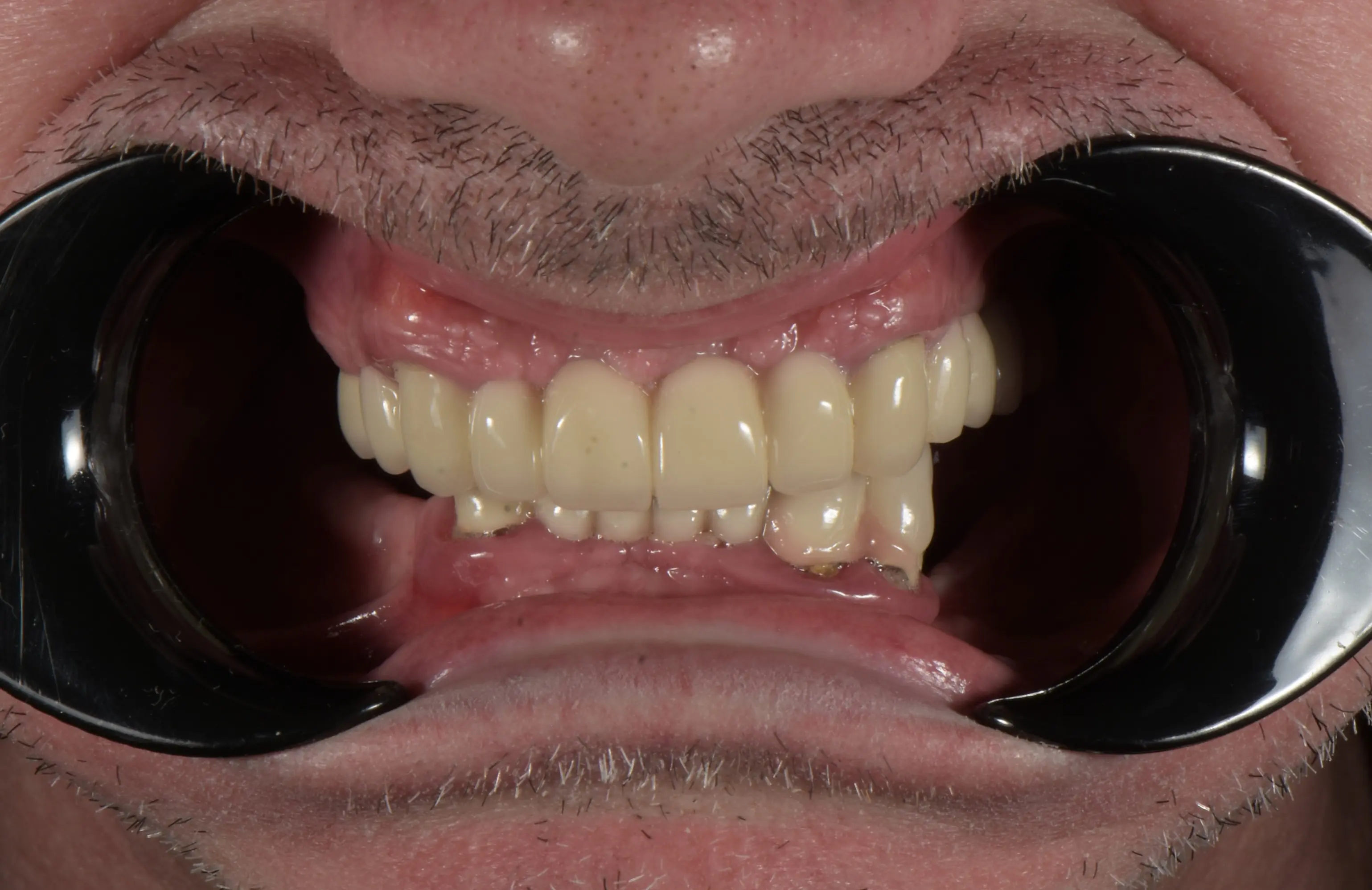 Before treatment