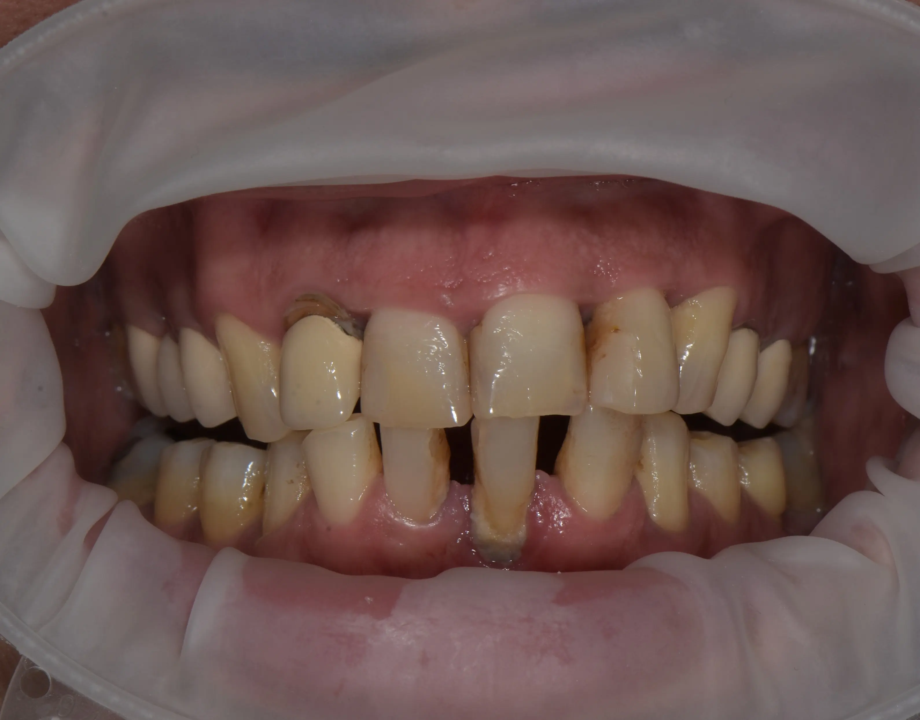 Before treatment