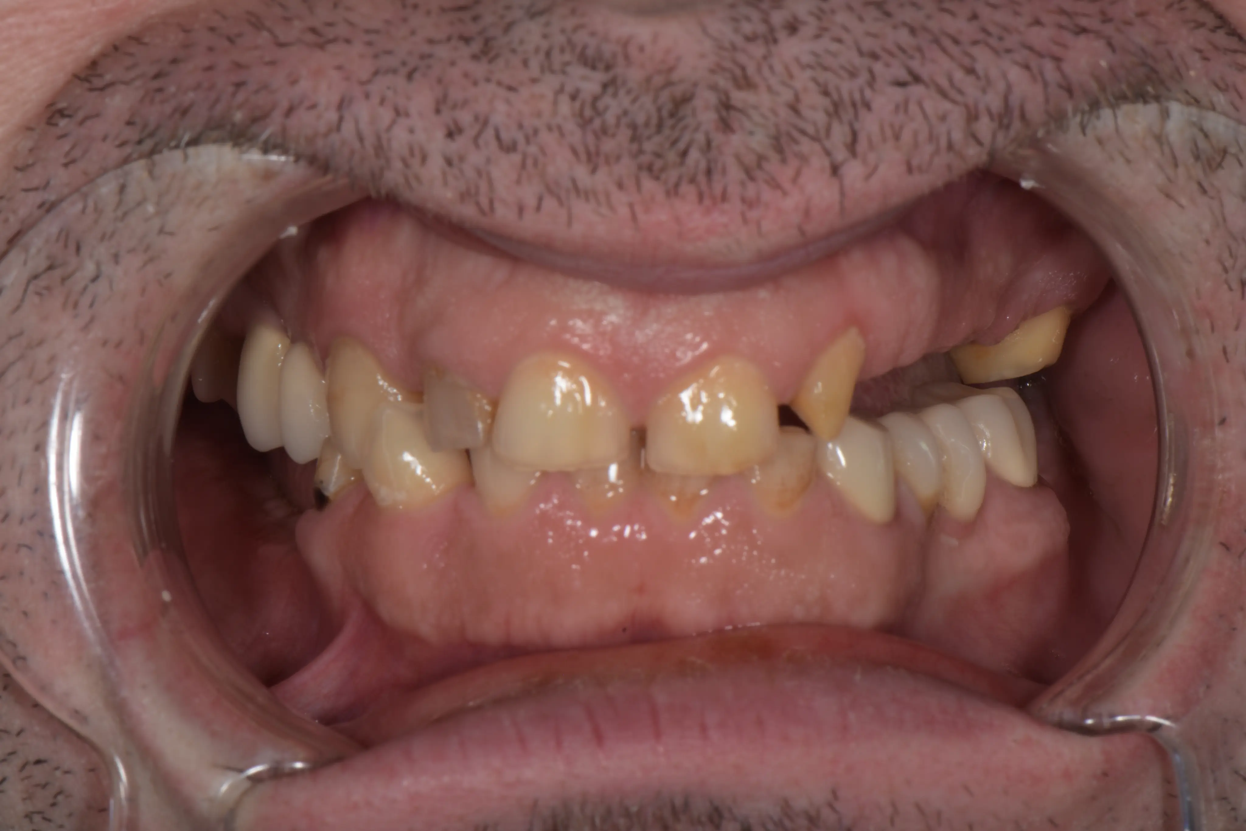 Before treatment