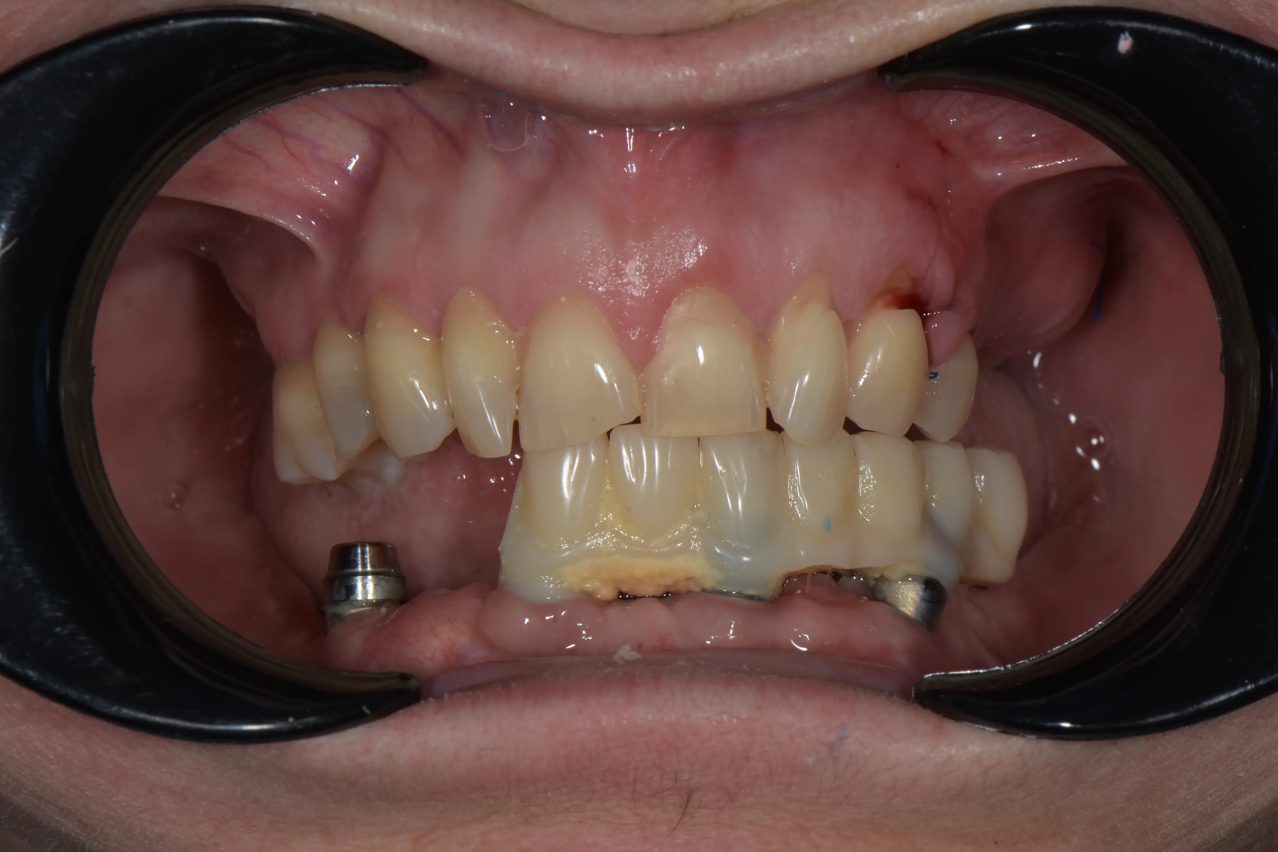 Before treatment