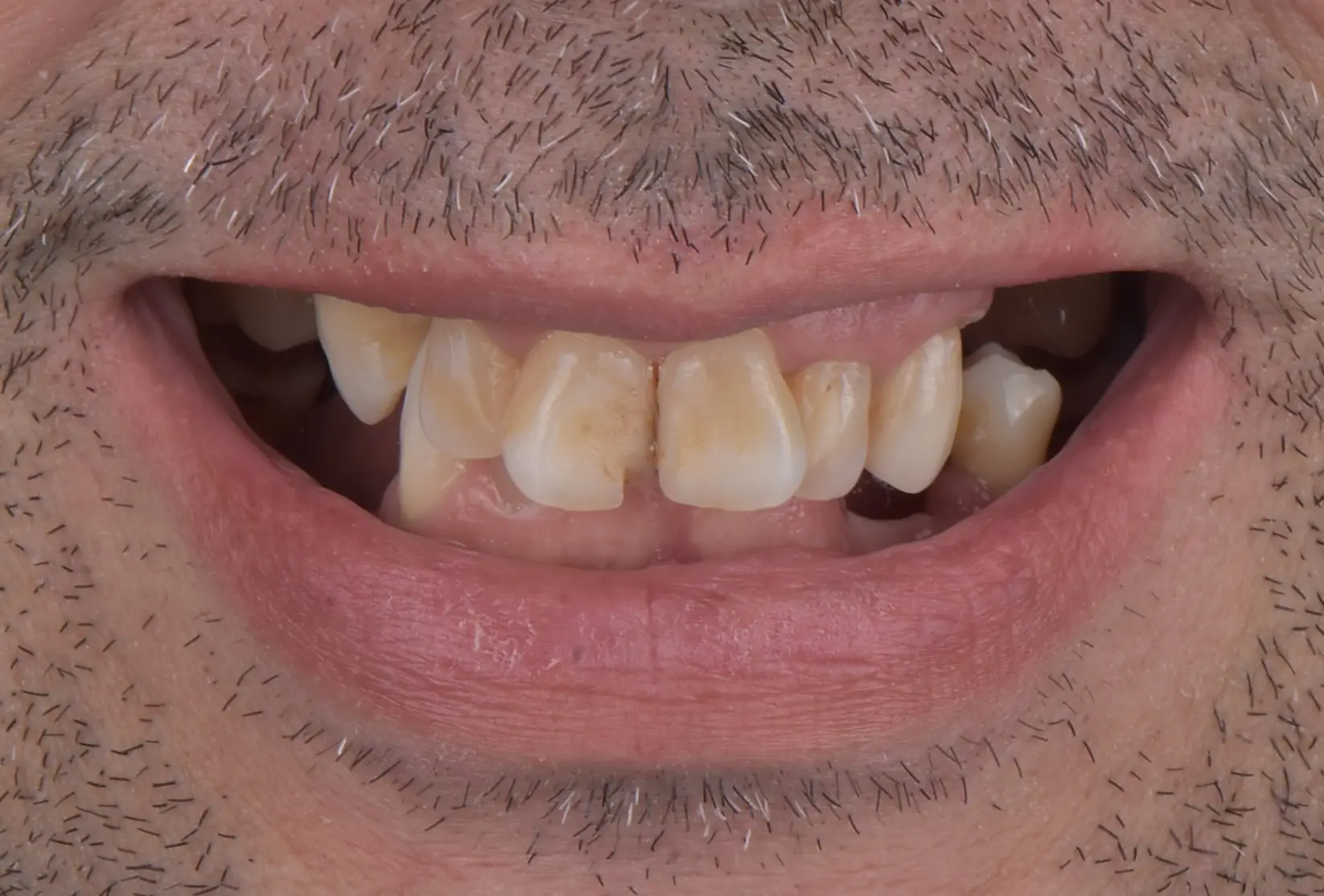 Before treatment