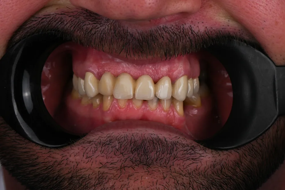 Ceramic crowns — Before
