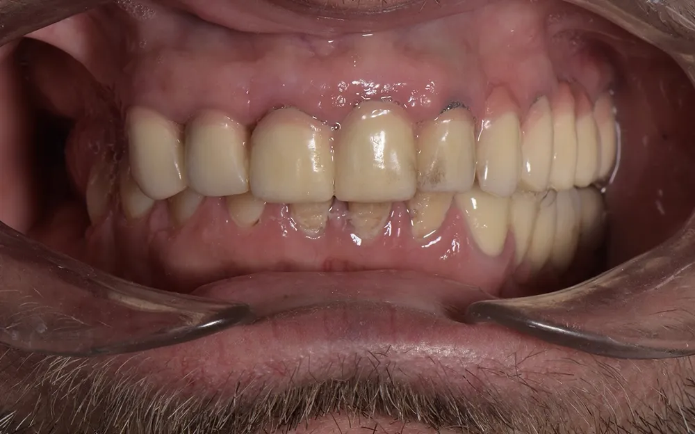 Ceramic crowns — Before